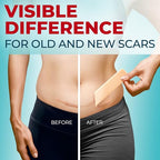 Medical Grade Silicone Scar Tape - 1.6”x150” - Visible Difference on Keloid & С-Section - Reusable Silicone Scar Sheets - Easy to Use