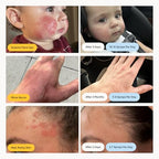 Skin Cleanser for All Skin Types, Hypochlorous Acid Spray Helps Heal Acne Prone Skin, Eczema and Itchy Rashes and 50 Other Skin Ailments, Safe for Multiple Daily Uses, 8 oz Spray