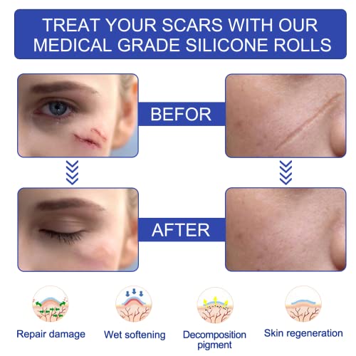 Silicone Scar Sheets - Gel Silicone Scar Tape (1.6” x 120”), Invisible Medical Grade Scar Silicone Strips, Transparent Removal Scar Patches for Keloids, Burn, C-Section, Acne
