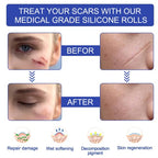 Silicone Scar Sheets - Gel Silicone Scar Tape (1.6” x 120”), Invisible Medical Grade Scar Silicone Strips, Transparent Removal Scar Patches for Keloids, Burn, C-Section, Acne