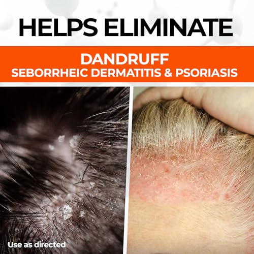 Medicasp Coal Tar Gel Anti Dandruff Shampoo, Treats Seborrheic Dermatitis & Psoriasis, Formulated for Dry, Flaky & Itchy Scalp Treatment, for Women & Men, 6 Ounce (Pack of 2)