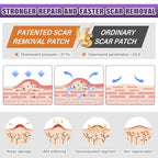 Silicone Scar Sheets,Silicone Scar Tape,Scar Tape for Surgical,C-Section,Tummy Tuck,Keloid(1.6"X 120" Roll-3M) Keloid Bump Removal