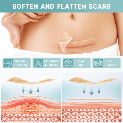 Losveo Silicone Scar Sheets for Face Wrinkles, Medical Grade Silicone Scar Sheets(1.6”x 120” Roll-3M) for Surgical Scars, C-Section, Burn, and Acne Scars- Reusable Scar Removal Strips
