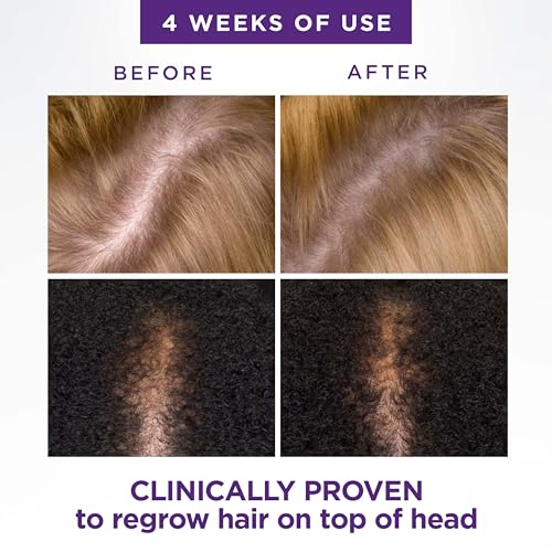 Head & Shoulders Scalp X 2% Minoxidil for Women, Hair Regrowth Treatment for Thinning Hair and Hair Loss, Topical Solution, 3 Month Supply, 2 Fl Oz Each, Pack of 3