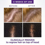 Head & Shoulders Scalp X 2% Minoxidil for Women, Hair Regrowth Treatment for Thinning Hair and Hair Loss, Topical Solution, 3 Month Supply, 2 Fl Oz Each, Pack of 3