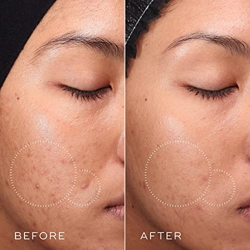 Medik8 Press and Clear - Clarifying Daily Facial Exfoliant - Exfoliating BHA Toner - Gentle-Release Salicylic Acid - Fast Action on Blemishes - 5 oz