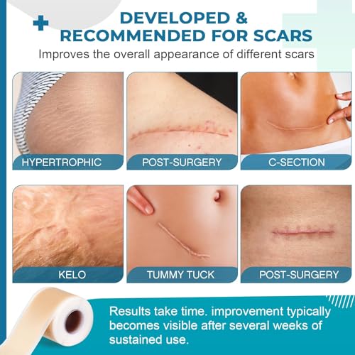Silicone Scar Sheets, Silicone Scar Tape(1.8”x 157” Roll-4M), Silicone Scar Strips, Professional Scar Removal Sheets for Surgical Scars, Keloid, C-Section, Burn et