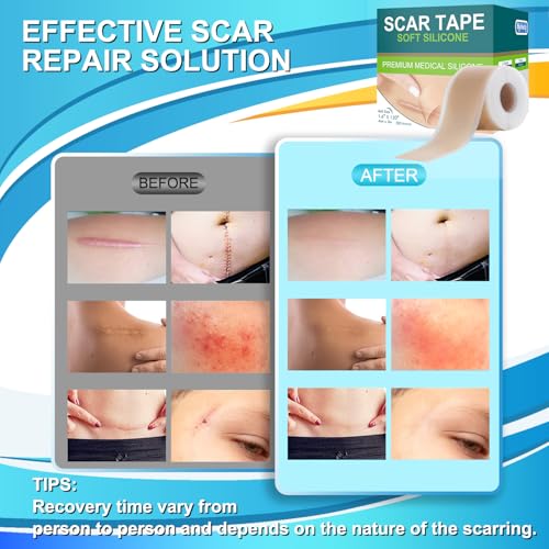 Medical Grade Silicone Scar Tape for Surgical Scars (1.6" x 120" - 3M) Professional Silicone Scar Sheets Scar Treatment for Face Wrinkles, C Section Recovery, Keloid Bump Removal Silicone Scar Patches