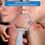 BioForce Pure Hypochlorous Acid Spray for Face & Body - Acne-Prone Skin & Eczema, Piercing aftercare, Made in Canada, Gentle Skin Cleanser & Toner, pH Balanced, Non-comedogenic (33 Oz)