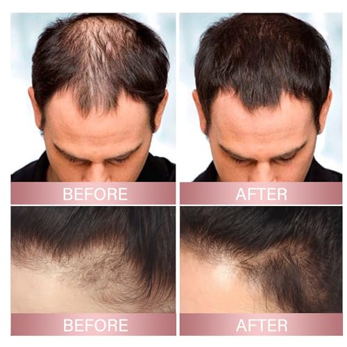 H-Regrow 2.0 - Hair Regrowth Spray with Biotin, Caffeine, Rice, Ginger, Castor Oil - 1PCS