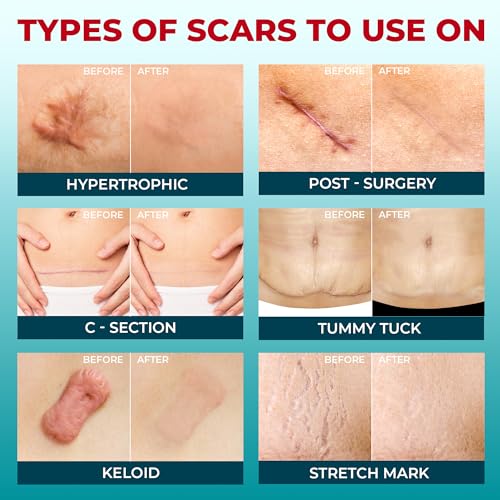 Medical Grade Silicone Scar Tape - 1.6”x150” - Visible Difference on Keloid & С-Section - Reusable Silicone Scar Sheets - Easy to Use
