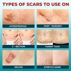 Medical Grade Silicone Scar Tape - 1.6”x150” - Visible Difference on Keloid & С-Section - Reusable Silicone Scar Sheets - Easy to Use