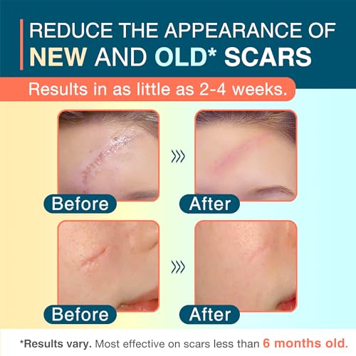 Silicone Scar Sheets, 1.5” x 156” Medical Silicone Scar Tape Roll, Reusable Scar Strips for Surgical, C-Section, Keloid Bump, Stretch Marks, Acne, Hypertrophic Scar Treatment