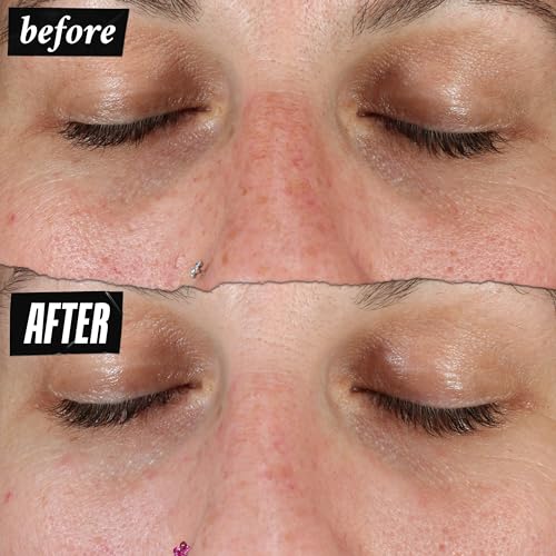 Kiehl's Clearly Corrective Dark Spot Serum, Brightening Facial Serum, Reduces Hyperpigmentation & Post-acne Marks, with Vitamin C & Salicylic Acid, All Skin Types, Paraben-free, Mineral Oil-free