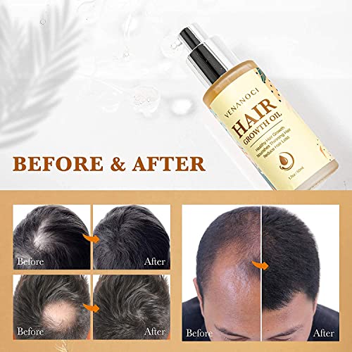 Veganic Natural Hair Growth Oil: Venanoci Hair Growth Serum with Biotin & Rosemary for Anti-Hair Loss, Hair Regrowth & Thickening – Strengthens & Nourishes Hair for Women & Men (2pcs)