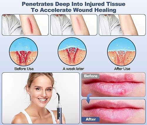 Red Light Therapy Device, Cold Sore Canker Sore Treatment Torch for Lips, Infrared Light Therapy Wand for Face Fever Blister, Healing Pain Relief for Mouth Nose Ear Knee Feet Hands Ankle Muscle Dogs