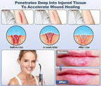 Red Light Therapy Device, Cold Sore Canker Sore Treatment Torch for Lips, Infrared Light Therapy Wand for Face Fever Blister, Healing Pain Relief for Mouth Nose Ear Knee Feet Hands Ankle Muscle Dogs