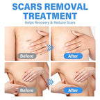 Silicone Scar Sheets, Silicone Scar Tape, Medical Grade Scar Removal Strips，Reusable and Effective Breast Silicone Scar Sheets, 4 Pair/Blue