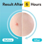 DERMA ANGEL Dark Spot Patches Blemish Patches with Hydrocolloid, TXA & CICA for Active Acne & Post-Inflammatory Dark Spots - Day and Night Use - UPGRADED (Post Acne - 96 Count - 1 Size)