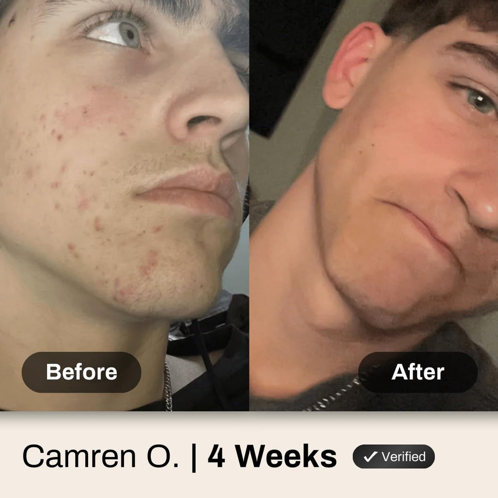 Acne System for Men and Boys, Face Wash, Moisturizer, Pimple Patches, Shield Men's Skin Care Set (4 Months)