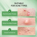 LANBENA Precision Acne Spot Serum, Acne Drying Lotion, Overnight Acne Treatment For Face, Dry Out Pimples, Blemishes, Zits And Clean Pores, 1 Fl Oz