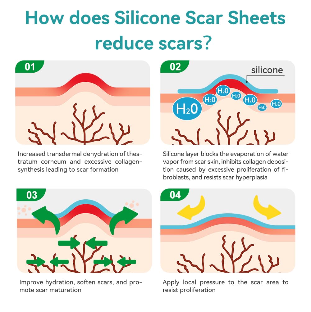 Dimora Medical Grade Silicone Scar Sheets - Ultra Soft Silicone Scar Tape (1.6”x120" Roll), Waterproof Scar Treatment for Surgical Scars, C Section, Tummy Tuck, Keloid Treatment