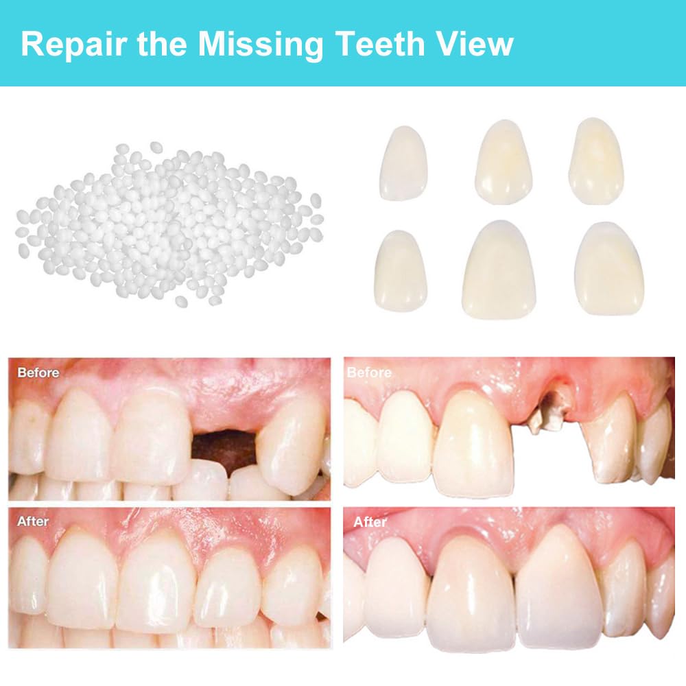 Brige Temporary Tooth Repair Missing Tooth- Moldable Fake Teeth Artfifical Teeth,Cosmetic Tooth Replacement Kit for Teeth Veneers