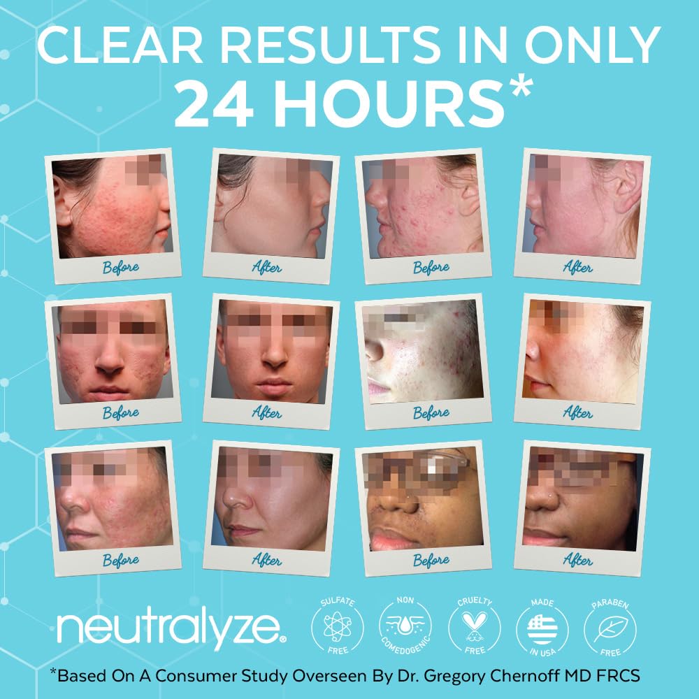 Neutralyze Exfoliating Acne Treatment Wipes - Maximum Strength, Textured Acne Pads with Mandelic Acid & Salicylic Acid for Face & Body - Suitable for All Skin Types, Teens & Adults (100 Wipes)
