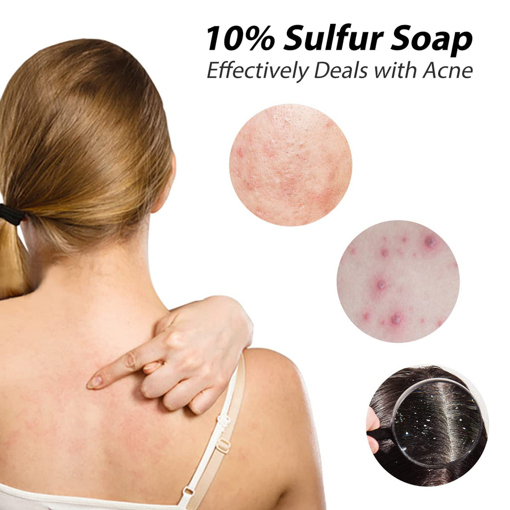 Bee & Flower Shanghai Sulfur Soap 10% Sulfur Soap Bar Face and Body Acne Treatment Sulphur Bar Soaps 3.4 Oz (6 Packs)