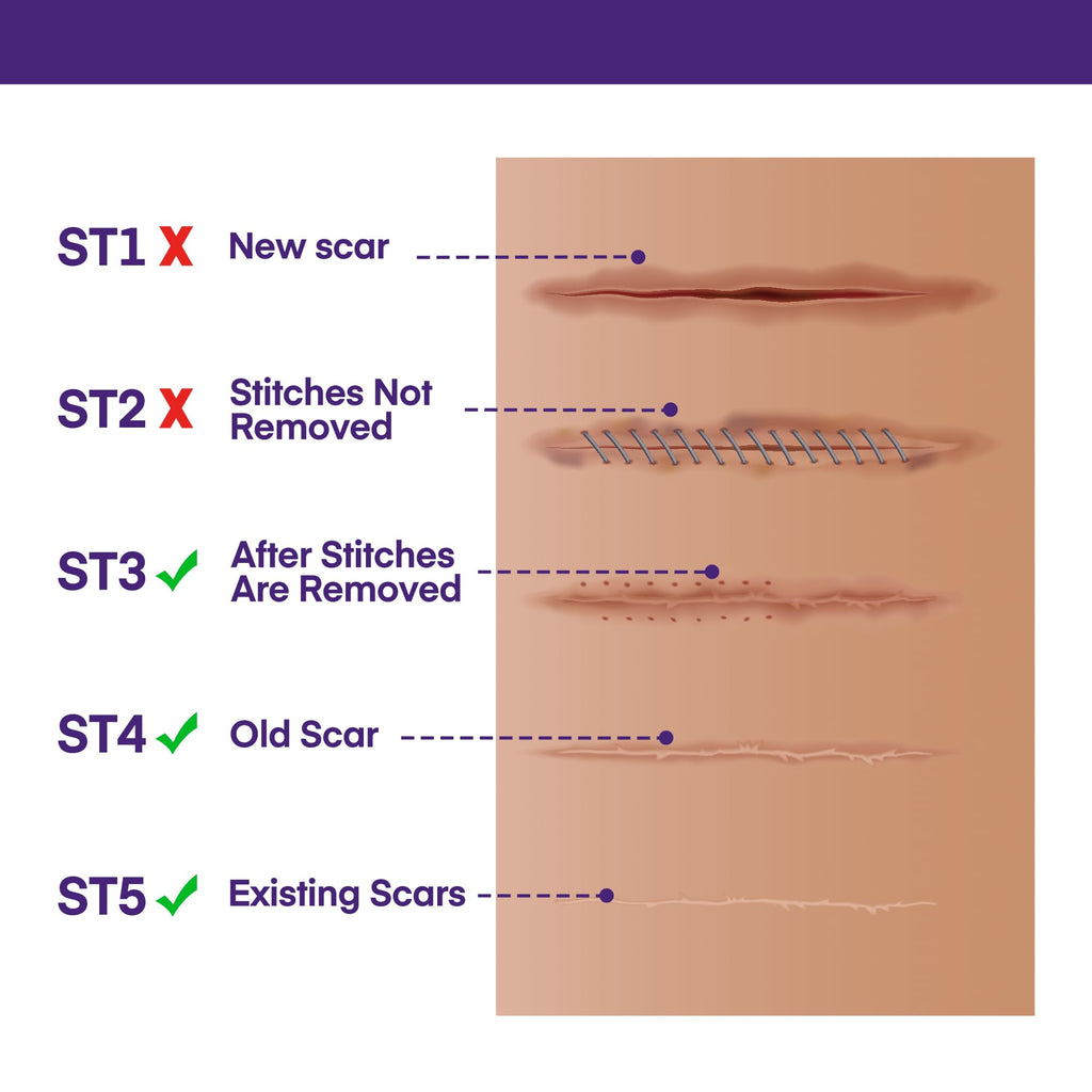 Silicone Scar Gel Scar Cream: SPF 30 Advanced Medical-Grade Formula for Surgical Scars, C-Section, Stretch Marks, Acne, Burns, Keloids, Old & New Scars – Broad Spectrum UV Protection 1.06oz (30g)