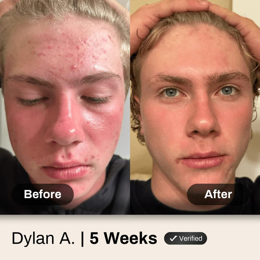 Acne System for Men and Boys, Face Wash, Moisturizer, Pimple Patches, Shield Men's Skin Care Set (4 Months)