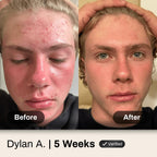 Acne System for Men and Boys, Face Wash, Moisturizer, Pimple Patches, Shield Men's Skin Care Set (4 Months)