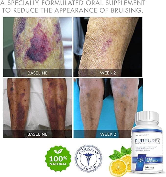 PURPUREX - Dietary Supplement for Bruising (30-Day Supply)
