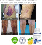 PURPUREX - Dietary Supplement for Bruising (30-Day Supply)