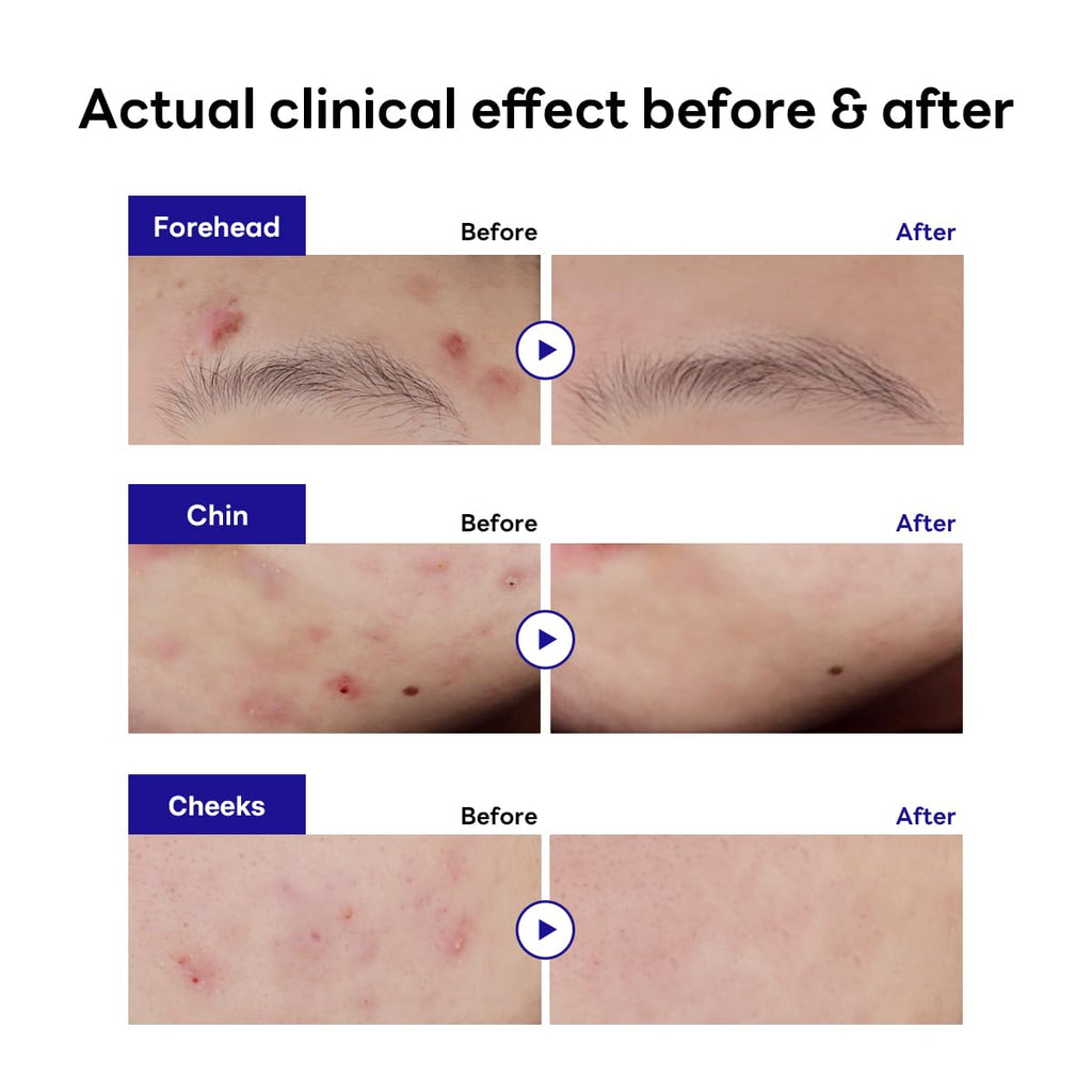 Mediheal Derma Clear Teatree Treatment Spot Patch (132 Counts) - Acne Relief, Oil and Moisture Balance with Teatree & Salicylic Acid