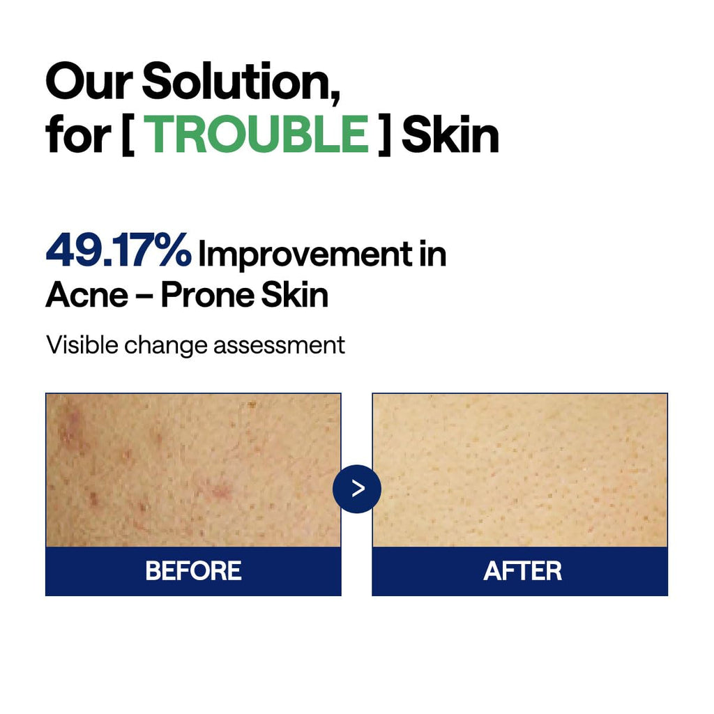 MEDIHEAL Teatree Trouble Pad - Square Cotton Facial Toner Pads with Tea Tree & Lactobacillus - Soothing to Calm Sensitive & Acne Prone Skin- Vegan Face Gauze 100