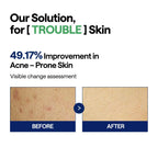 MEDIHEAL Teatree Trouble Pad - Square Cotton Facial Toner Pads with Tea Tree & Lactobacillus - Soothing to Calm Sensitive & Acne Prone Skin- Vegan Face Gauze 100