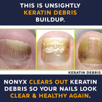 NONYX Fungal Nail Clarifying Gel | Clinically Proven for Discolored, Thick, Brittle, Yellow, Lifted, and other signs of Fungus-Damaged Toenails | 90% of Nails Improve | Over 8 million sold