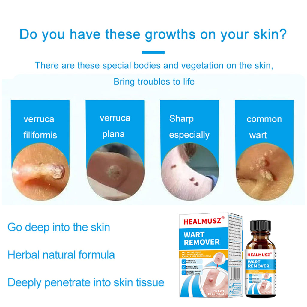 Skin-Tag-Remover, Wart Remover, Mole & Wart-Remover Liquid, Fast-Acting Skin-Tag-Remover for Tag Removal & Verruca-Treatment