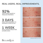 BellamiLuxx Folliculitis Acne Lotion for Body: Helps Reduce Itch, Redness, Body Acne, Bumps & Uneven Texture with Salicylic & Glycolic Acid + Botanicals - Gentle Care for Folliculitis-Prone Skin