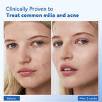 Milia Remover for face and eyes: Milia remover treatment with 3% Salicylic Acid for Acne exfoliant, Advanced formula for Men and Women 30ML