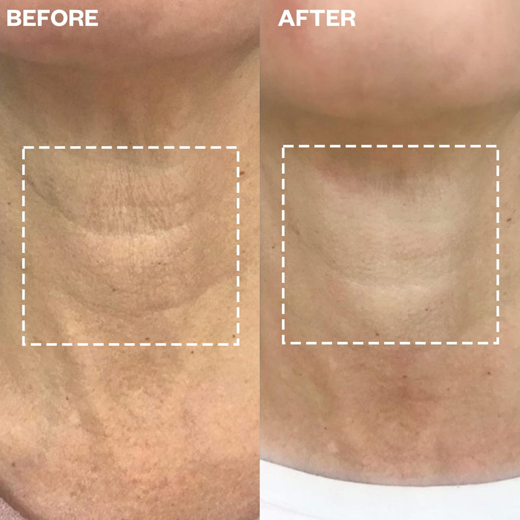 Wrinkles Schminkles Neck Wrinkle Patch - Reusable Silicone Smoothing Pads, Sensitively Formulated Wrinkle Patches. Reduce Wrinkles - Innovative Wrinkle Treatment - Targeting Neck Wrinkles (1 Pack)