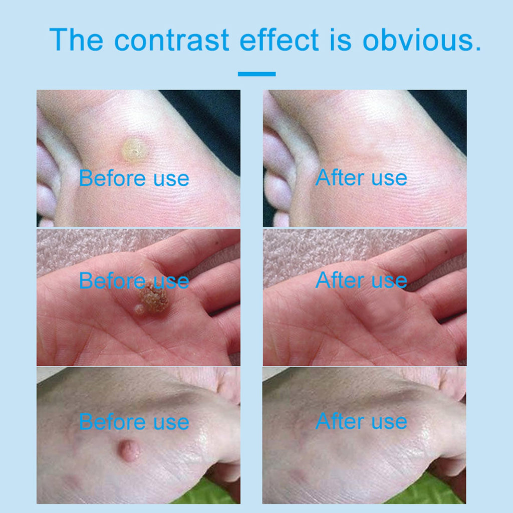 Skin-Tag-Remover, Wart Remover, Mole & Wart-Remover Liquid, Fast-Acting Skin-Tag-Remover for Tag Removal & Verruca-Treatment