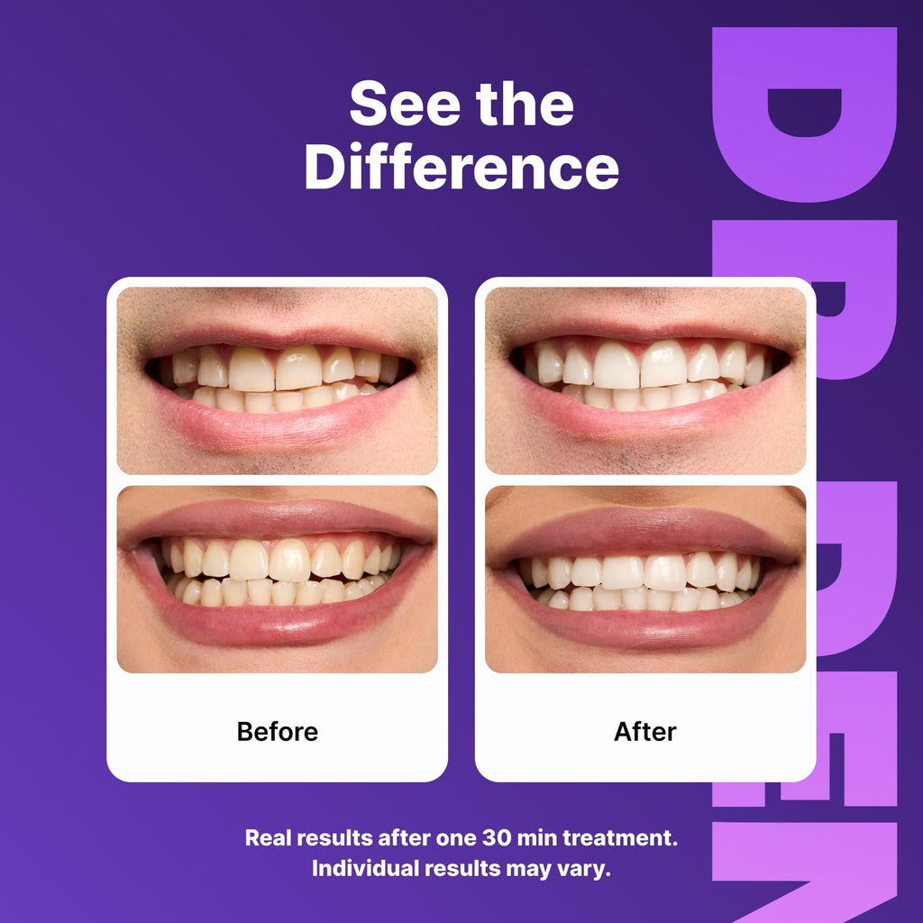 DrDent Professional Teeth Whitening Strips 21 Treatments - Safe for Enamel - Non Sensitive Teeth Whitening - Whitening Without Any Harm - Pack of 42 Strips + Mouth Opener Included