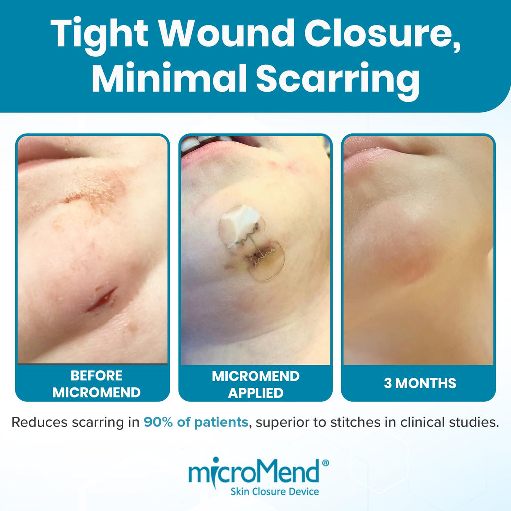microMend Emergency Wound Closures - Surgical-Grade Laceration Repair Without Stitches | Skin Closure Alternative to Butterfly Bandages | First Aid Kit Essential (6 Medium Wound Closure Devices)