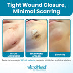 microMend Emergency Wound Closures - Surgical-Grade Laceration Repair Without Stitches | Skin Closure Alternative to Butterfly Bandages | First Aid Kit Essential (6 Medium Wound Closure Devices)
