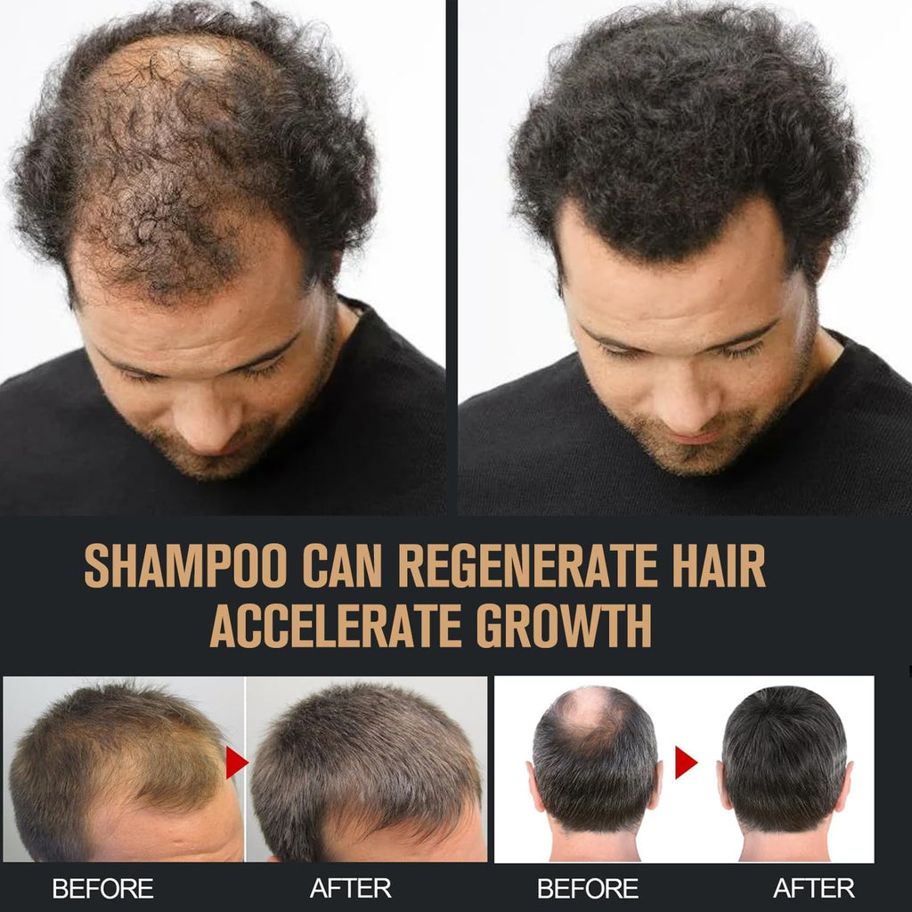 2PCS Root Activator Shampoo, Hair Growth Root Activator Shampoo, for Smooth and Strong Hair Restoration