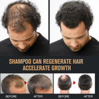 2PCS Root Activator Shampoo, Hair Growth Root Activator Shampoo, for Smooth and Strong Hair Restoration