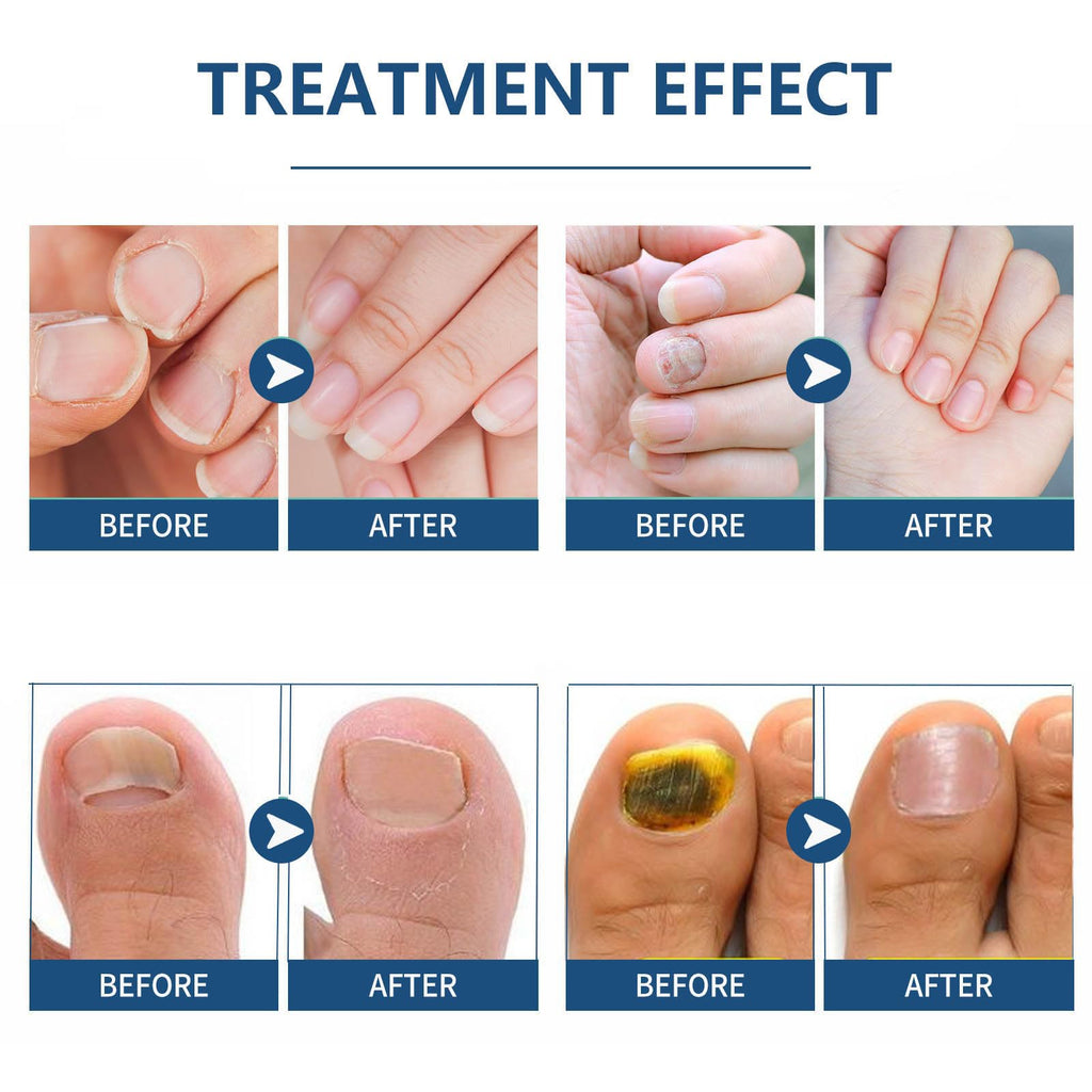64PCS Fungal Nail Patches, Fungal Nail Treatment for Toenails Extra Strong, Fast-Acting Nail Fungal Treatment Patches for Damaged & Thick Nails, Overnight Repair & Long-Lasting Relief