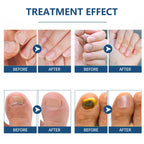 64PCS Fungal Nail Patches, Fungal Nail Treatment for Toenails Extra Strong, Fast-Acting Nail Fungal Treatment Patches for Damaged & Thick Nails, Overnight Repair & Long-Lasting Relief